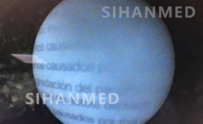 硬性輸尿管鏡的結(jié)構(gòu)及Wolf輸尿管鏡8968.405的維修案例